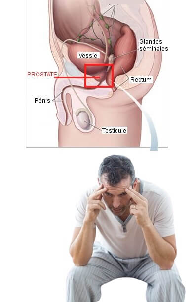 ubat prostat paling berkesan